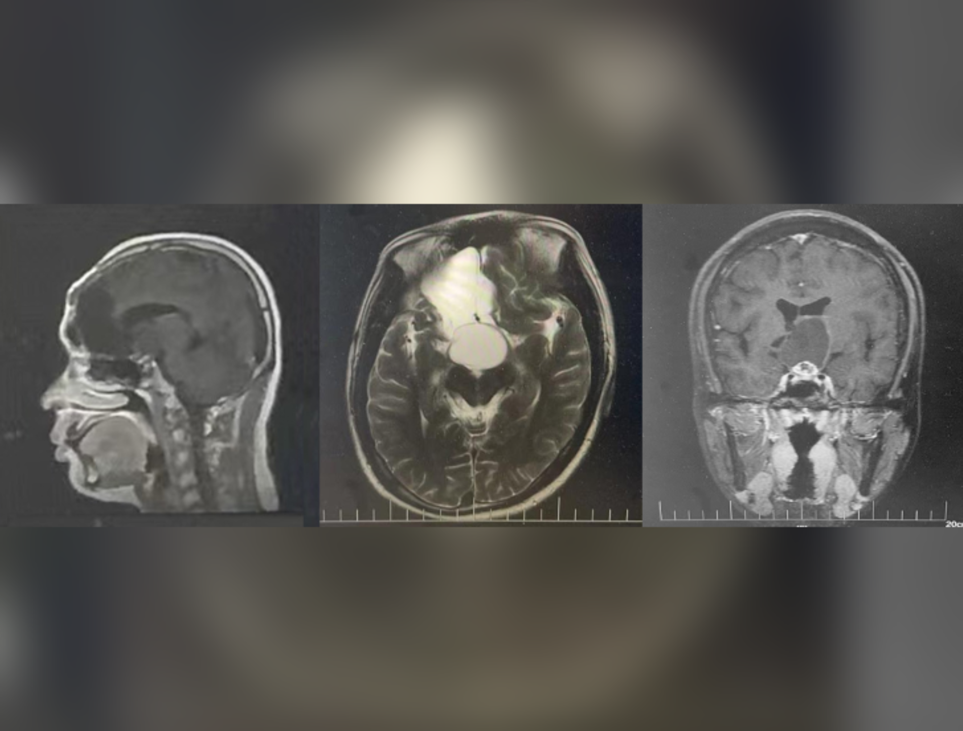 Case report 丨Skull base reconstruction strategies in endoscopic endonasa surgery for recurrent craniopharyngioma