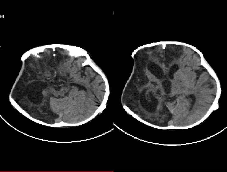 Case Report | Exposure Techniques in Pediatric PEEK Cranioplasty: Focus on Antisepsis, Vascular Preservation, and Subdural Effusion Prevention
